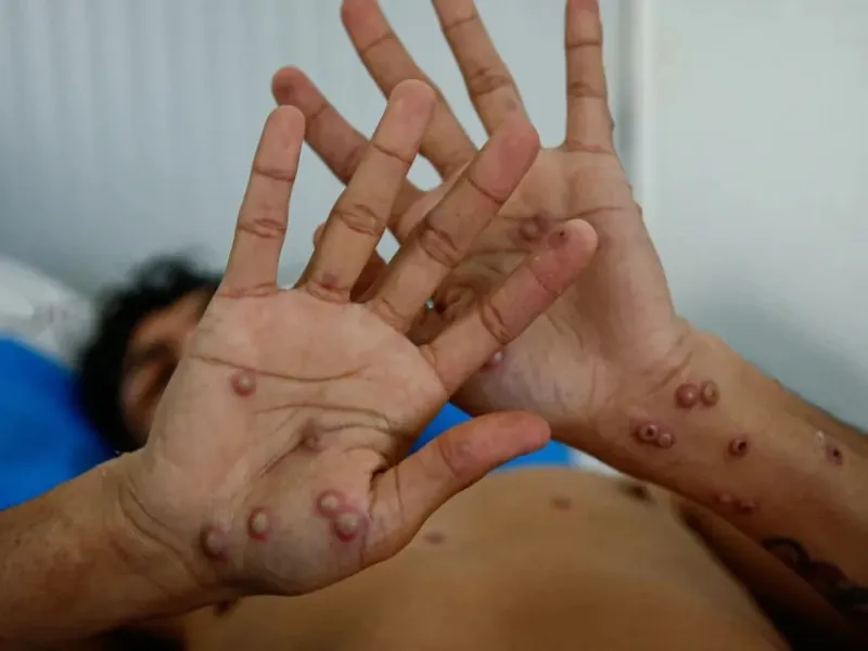 casos-viruela-del-mono-coruña-alerta-sanitaria-galicia|Foto: Europa Press